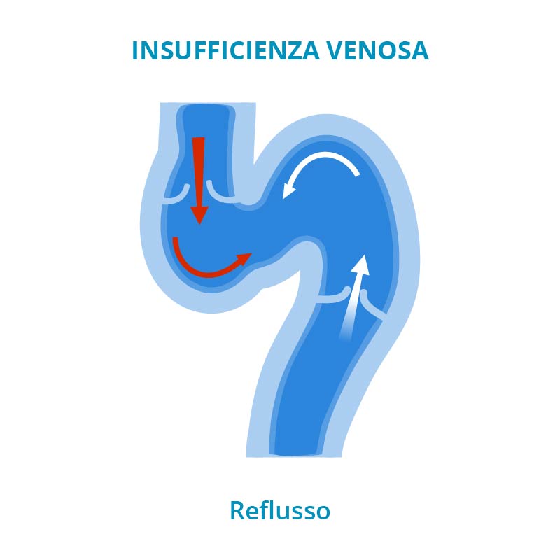 reflusso venoso